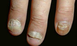 Отслаивается ноготь на руке: возможные причины, особенности ногтевой пластины, способы лечения, полезные советы от специалистов Некачественный уход и маникюр
