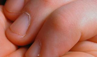 Причины появления заусенцев на пальцах и как от них избавиться